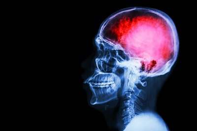Helping Your Loved One Recover From Traumatic Brain Injury